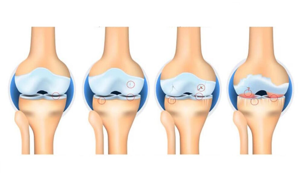stages of osteoarthritis of the knee