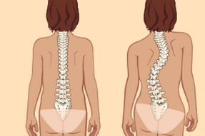 upright posture and scoliosis with thoracic osteochondrosis