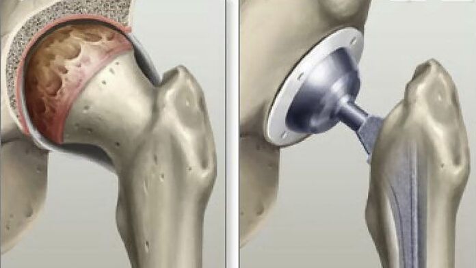 Endoprosthesis of the hip joint in the final stages of coxarthrosis