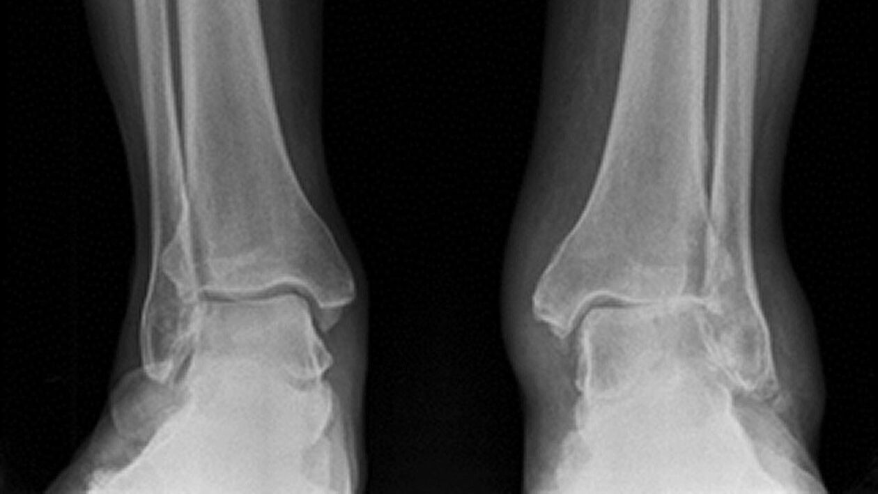 x-ray of the ankle