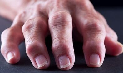 What is the difference between arthritis from arthrosis