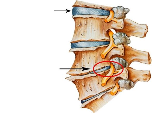Violations in the intervertebral discs