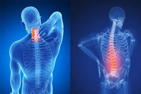 Osteochondrosis of the cervical and lumbar vertebrae