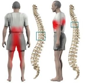 Lumps in the spine