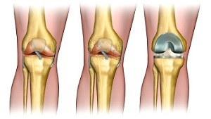 endoprosthesis for osteoarthritis of the knee joint